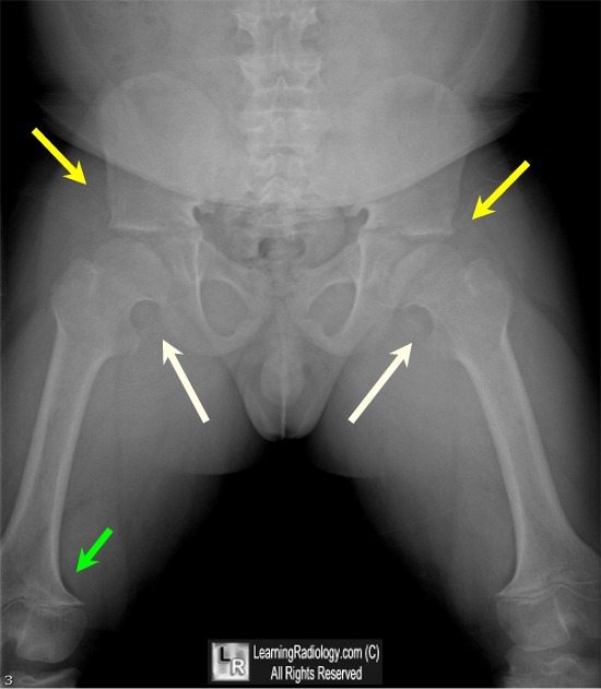 achondroplasia
